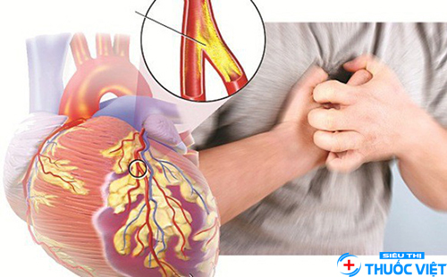 Tìm hiểu các phương pháp điều trị bệnh động mạch vành hiệu quả