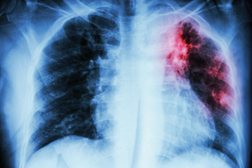 Bệnh lao phổi là bệnh gì?