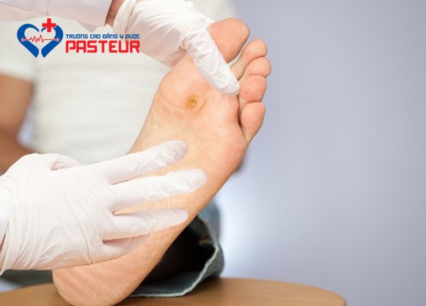 Những tổn thương thường gặp ở bàn chân người bệnh đái tháo đường