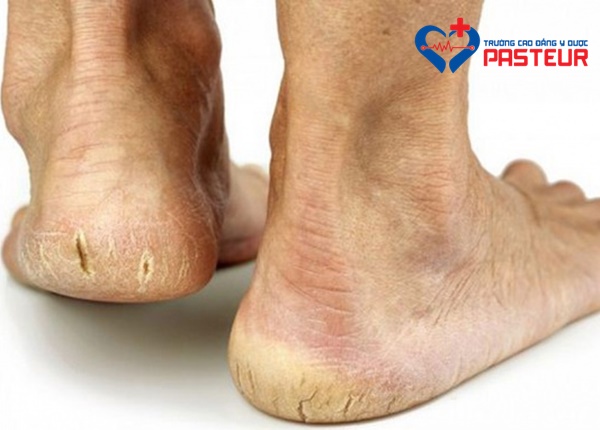 Nguyên nhân và phương pháp trị nứt gót chân