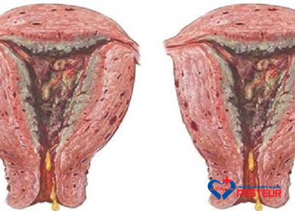 Hình ảnh ung thư cổ tử cung