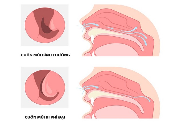 <center><em>Nghẹt mũi là do tình trạng co giãn quá mức các mạch máu ở mũi dẫn đến tắc nghẽn lưu thông đường thở.</em></center>