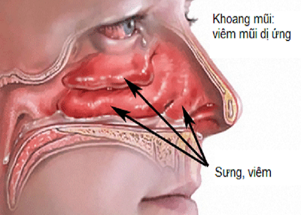 <center><em>Viêm mũi dị ứng có biểu hiện đặc trưng nhất là nghẹt mũi và chảy nước mũi.</em></center>